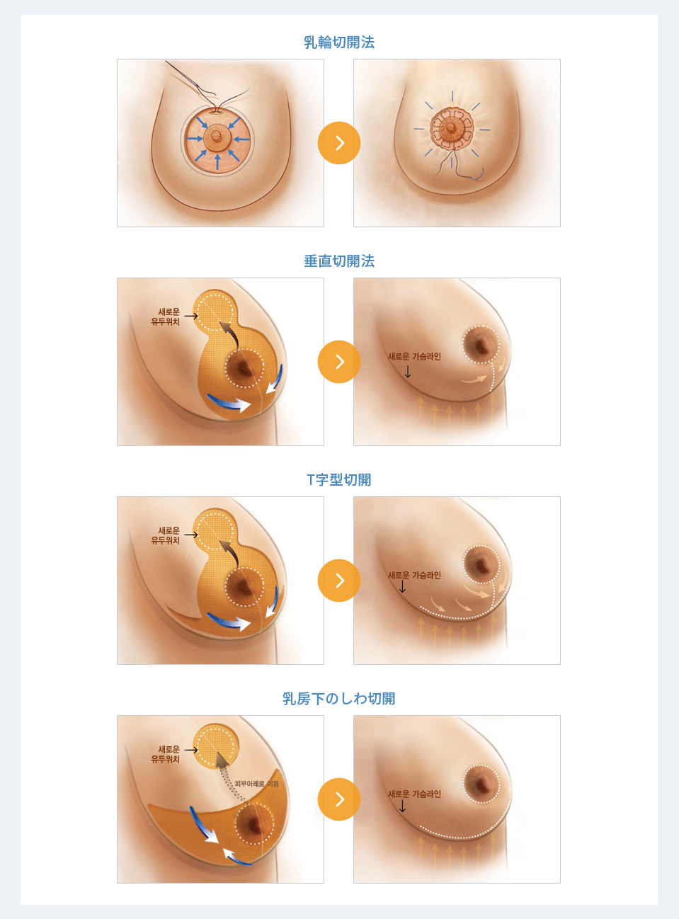 乳 輪 しわしわ